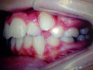 Tratamento odontológico antes