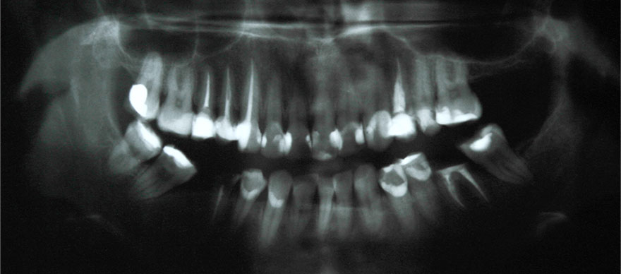 endodontia tratamento de canal